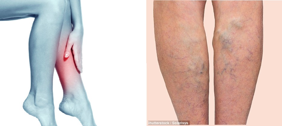 Nghiên cứu mới đây của các nhà khoa học cho thấy nổi mạch máu ở chân liên quan đến nhiều bệnh nguy hiểm