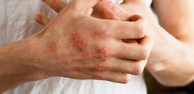 Da bị mẩn ngứa, phát ban có thể là dấu hiệu của bệnh thận