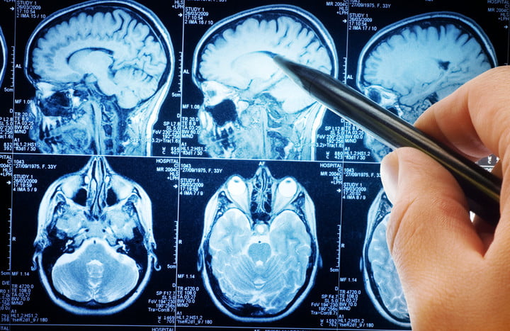   Một số trường hợp đau đầu nhiều cần chụp scan não để chẩn đoán đúng bệnh  
