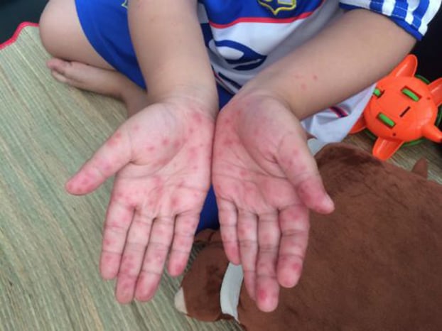   Bóng nước xuất hiện ở lòng bàn tay là cảnh báo sớm của bệnh tay chân miệng ở trẻ  