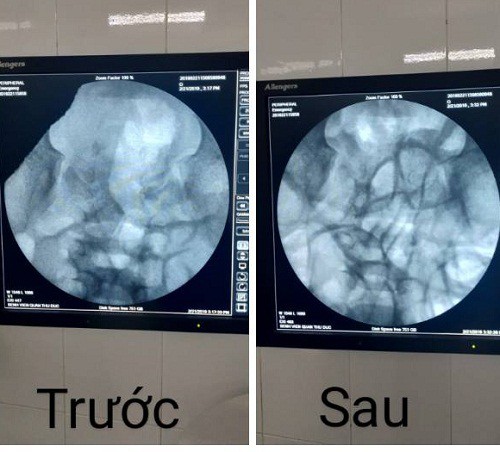   Hình ảnh bé bị lồng ruột trước và sau khi tháo.  