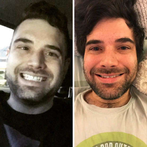   Trước và sau khi phẫu thuật lác mắt  