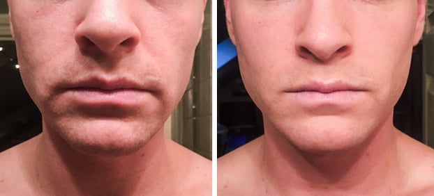   Hai tháng dưỡng ẩm da và kết quả  