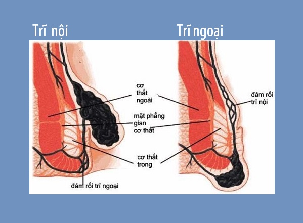   Hình mô tả đám rối trĩ nội và đám rối trĩ ngoại  