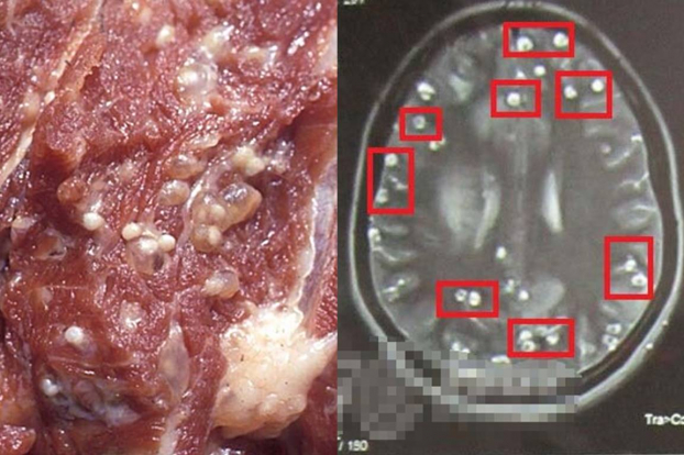  Hình ảnh sán lợn làm tổ dày đặc trong não người bệnh  