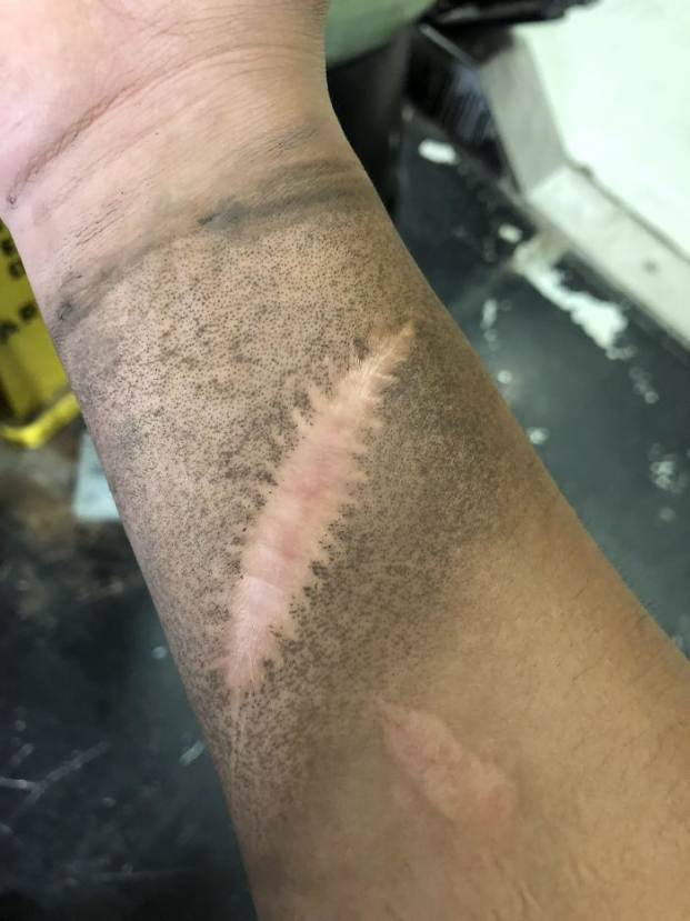   'Vết sẹo trên tay tôi không hề bị bẩn khi tôi làm việc'  