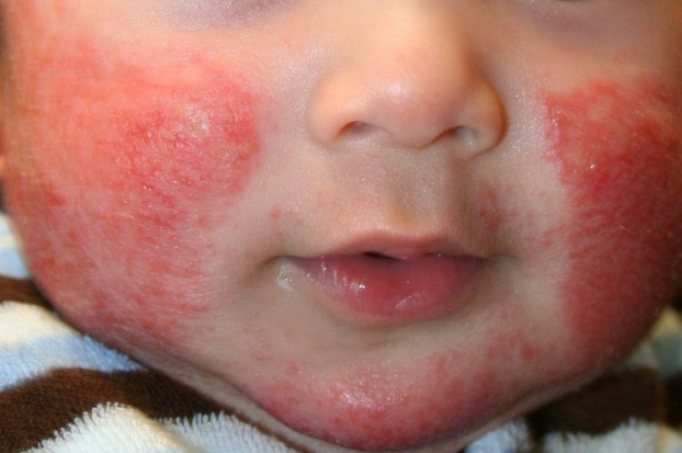   Viêm da cơ địa ở mặt là bệnh lý về da dễ gặp ở trẻ nhỏ  
