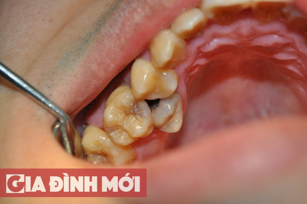 Bệnh sâu răng: Nguyên nhân và cách điều trị 2