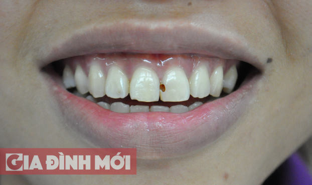   Sâu răng xảy ra ở bất kỳ vị trí nào của răng, từ răng hàm tới răng cửa  