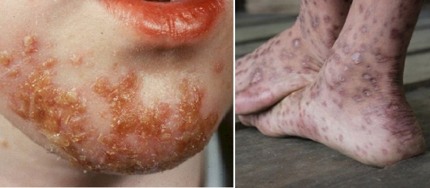   Viêm da cơ địa biến chứng viêm nhiễm nặng và để lại sẹo xấu trên da  
