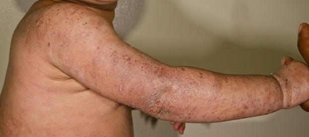   Viêm da cơ địa có thể gây viêm nhiễm nặng và để lại nhiều sẹo xấu  