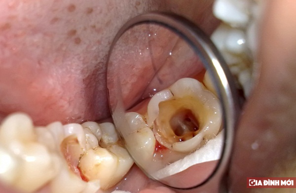 Sức khỏe răng miệng ảnh hưởng tới hôn nhân gia đình như thế nào? 2