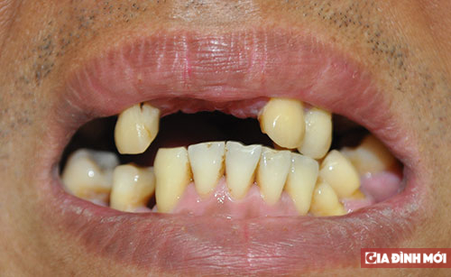 Sức khỏe răng miệng ảnh hưởng tới hôn nhân gia đình như thế nào? 4