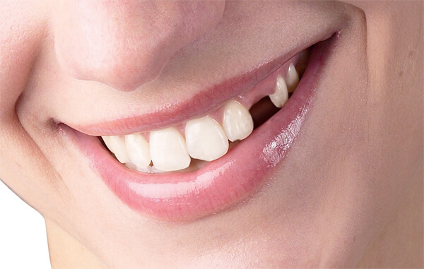 Sức khỏe răng miệng ảnh hưởng tới hôn nhân gia đình như thế nào? 7