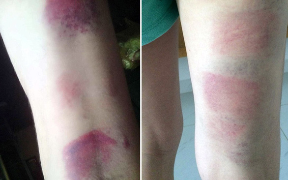   Một số em học sinh bị tím bầm chân vì cô giáo đánh.  