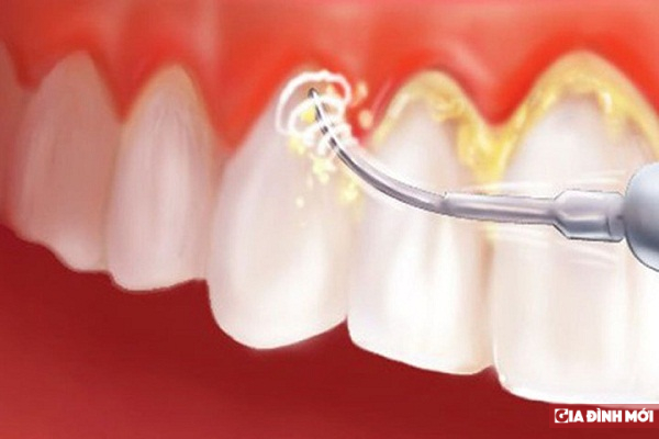Tác hại của vôi răng (cao răng) 4