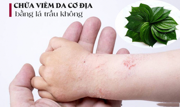   Chữa viêm da cơ địa bằng lá trầu không cho hiệu quả tốt và an toàn với da  