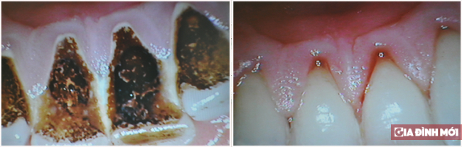 Tác hại của vôi răng (cao răng) 2