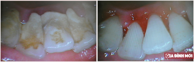 Tác hại của vôi răng (cao răng) 0