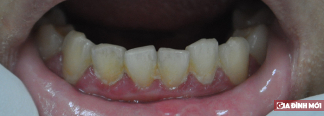 Tác hại của vôi răng (cao răng) 1