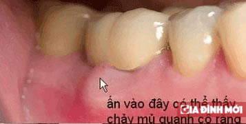 Bệnh nha chu – nguyên nhân hàng đầu làm rụng răng! 1