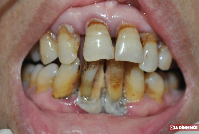 Bệnh nha chu – nguyên nhân hàng đầu làm rụng răng! 2