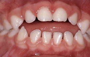 Những thói quen xấu làm xấu hàm răng ở trẻ nhỏ 1