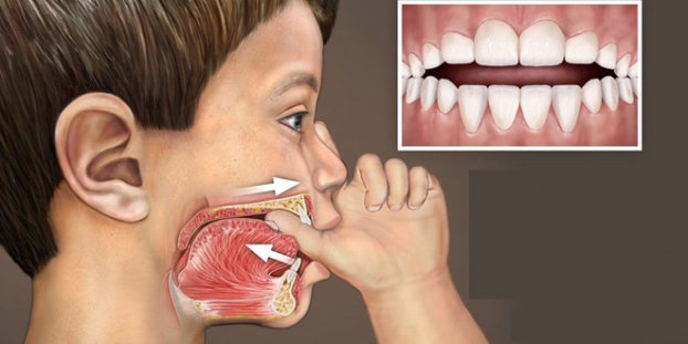 Những thói quen xấu làm xấu hàm răng ở trẻ nhỏ 0