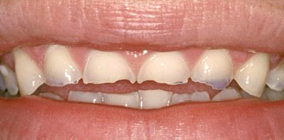 Những thói quen xấu làm xấu hàm răng ở trẻ nhỏ 3