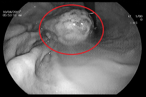   Hình ảnh khối bã thức ăn trong dạ dày bệnh nhân  
