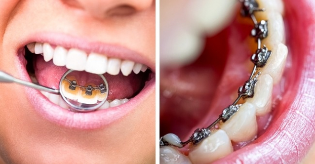 8 sai lầm lớn nhiều người hay mắc phải khi chăm sóc răng miệng 5