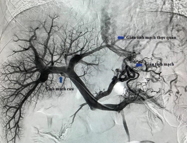   Hình ảnh hệ tĩnh mạch cửa và các búi giãn tĩnh mạch thực quản của bệnh nhân trước can thiệp TIPS. (Ảnh: BVCC)  