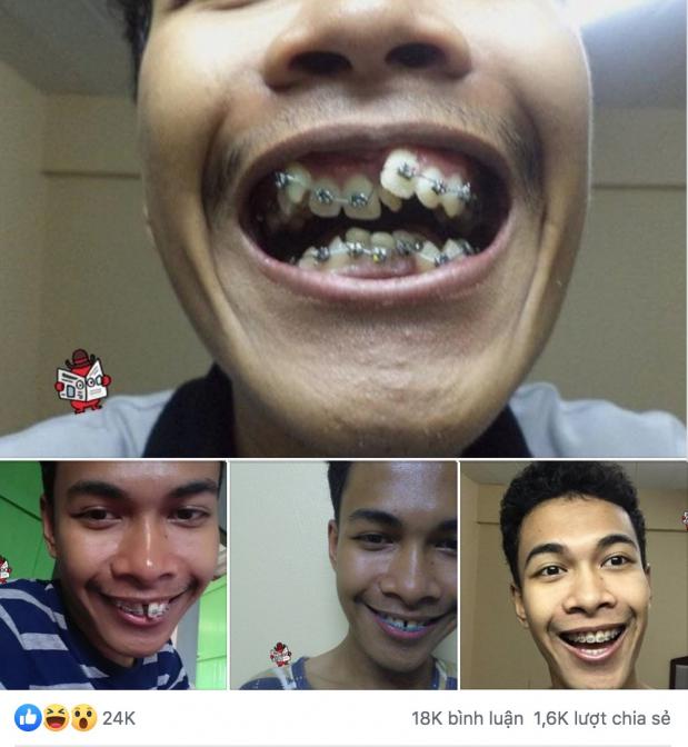   Pha niềng răng của một anh chàng người Thái thu hút nhiều sự quan tâm của mạng xã hội  