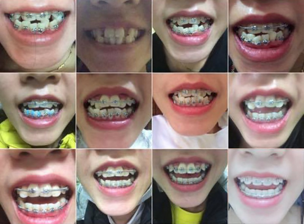   Quá trình niềng răng của một bạn nữ sau 8 tháng có những thay đổi đáng kể  