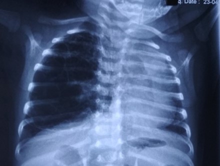   Dị dang nang tuyến phổi phải đè đẩy khí quản và tim sang đối diện.  