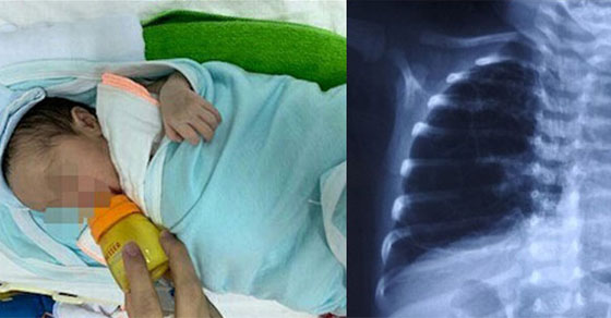   Bé Nguyễn Duy A bị được mẹ phát hiện bị dị dạng đường dẫn khí phổi từ trong bào thai.  