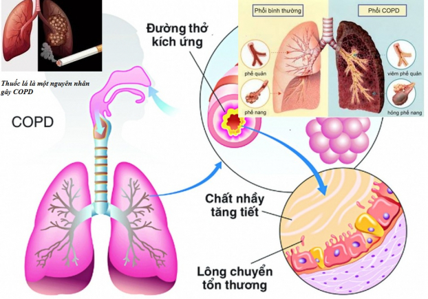   Tổn thương phổi trong bệnh phổi tắc nghẽn mạn tính. Ảnh min họa  