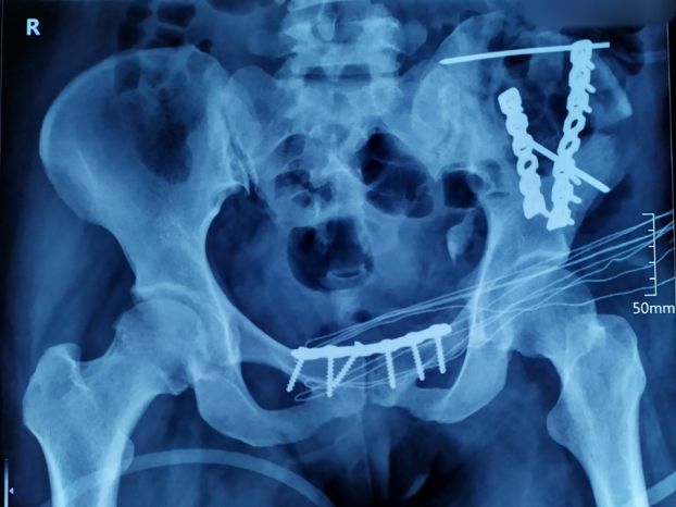   Những mảnh xương chậu bị vỡ nát được các bác sĩ đặt lại đúng vị trí  