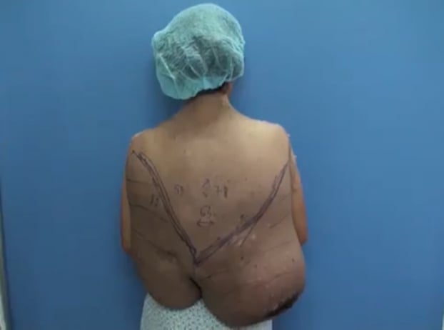   Khối u nặng 12kg trên lưng bệnh nhân trước khi được phẫu thuật  