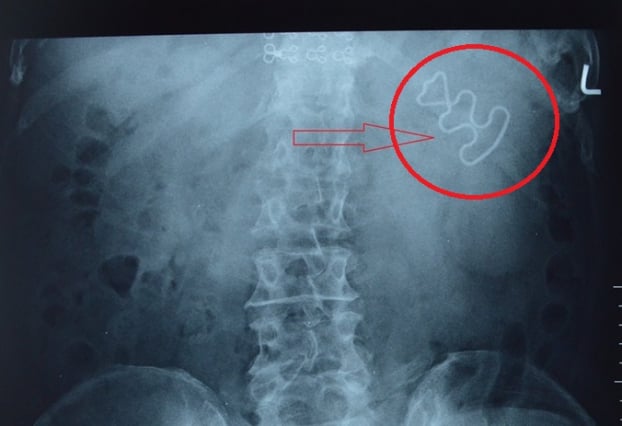   Hình ảnh vòng tránh thai đi lạc trong ổ bụng bệnh nhân  