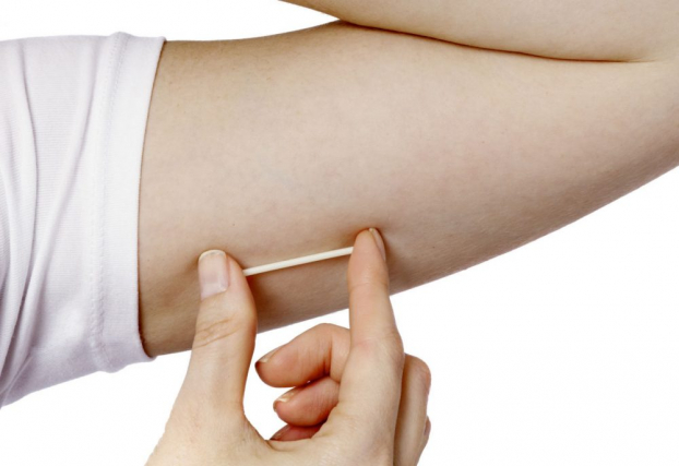   Cấy que ngừa thai dưới da cánh tay ngay sau sinh giúp tránh thai hiệu quả  