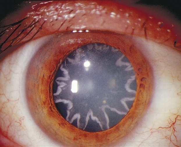   Đôi mắt của một kỹ sư điện sau khi bị giật bởi dòng điện 14kV  