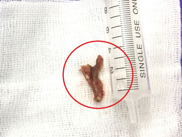   Mảnh xương cá lớn được gắp ra khỏi phế quản của bệnh nhân  