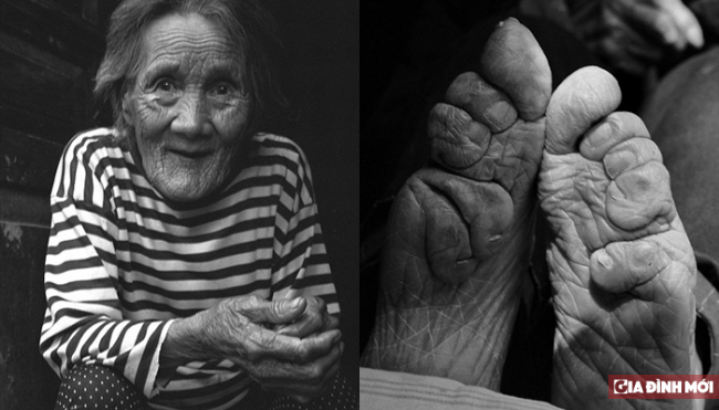   Bà Cao Mai Linh 87 tuổi, bà đã bó chân từ khi 3 tuổi và đã bó chân được 84 năm  