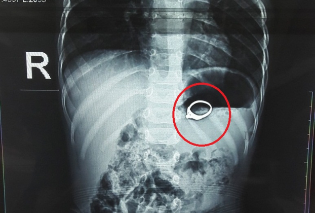   Hình ảnh chiếc nhẫn gắn đá trong bụng bệnh nhi  