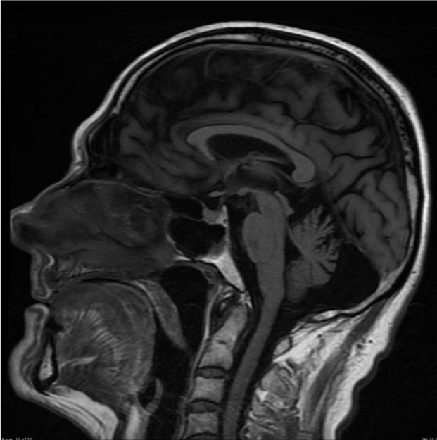   Ảnh chụp X-quang một bệnh nhân nghiện rượu bị teo não  