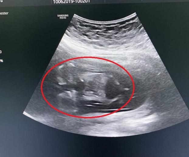  Hình ảnh song thai dính nhau có chung một quả tim  