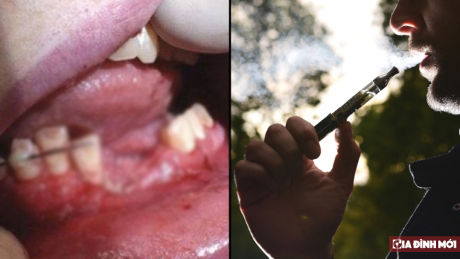   Thuốc lá điện tử phát nổ trong miệng khiến nam sinh gãy răng, vỡ xương hàm  