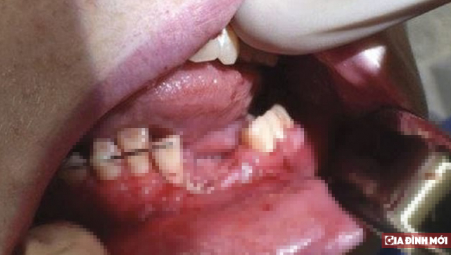 Thuốc lá điện tử phát nổ trong miệng khiến nam sinh gãy răng, vỡ xương hàm 1