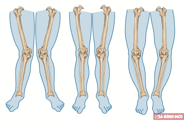   3 loại cấu trúc xương phổ biến khiến chân bị cong  